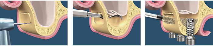 sinus lift