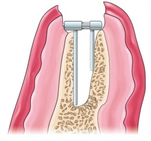 nivelacija alveolarnog grebena