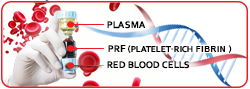 prf-metoda