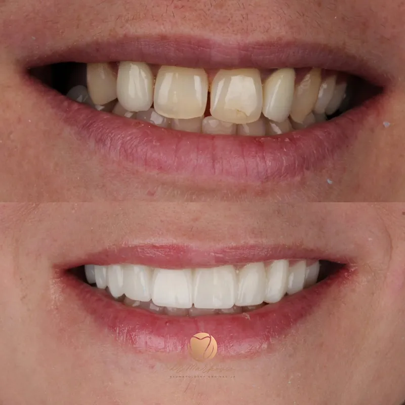 Transformacija osmijeha – fotografija 13